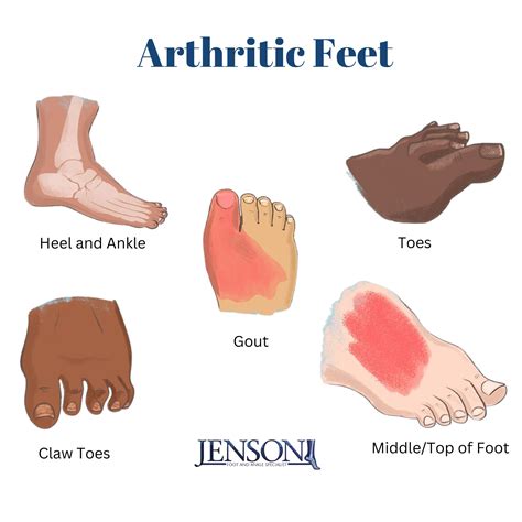Doctor’s Inc. | Ever wondered what Psoriatic Arthritis can do to your feet? This condition can ...
