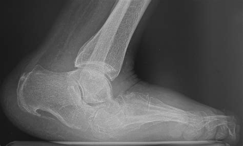 The Charcot foot | Bone & Joint