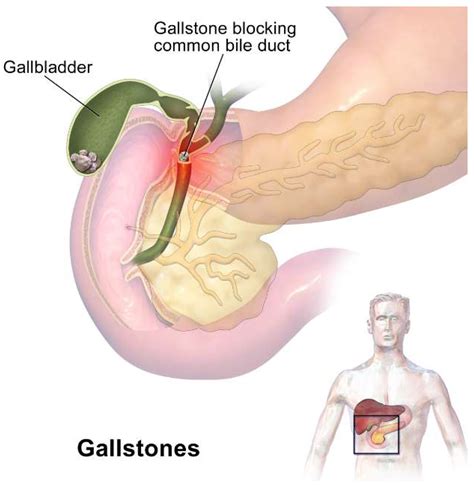 The Role of the Gallbladder, the Intestinal Barrier and the Gut Microbiota in the Development of ...