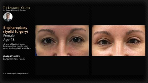Experienced Eyelid Surgery (Blepharoplasty) | Dr Langdon & Dr Sarhan | Guilford & Shoreline CT