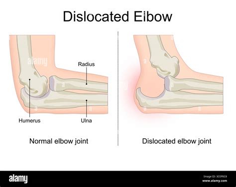 Elbow dislocated hand bone Illustration Stock Photo - Alamy