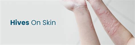 Skin Hives: Causes, Symptoms, Diagnosis and Treatment