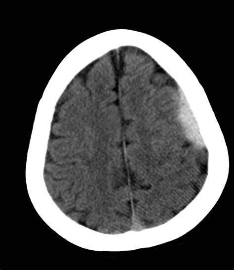 Subdural Hemorrhage