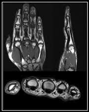 Image result for High-Resolution Hand MRI