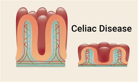 Researchers develop non-invasive method for diagnosis of celiac disease