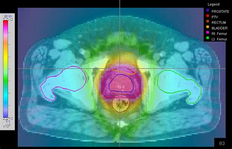 Prostate Radiation Simulation 的图像结果