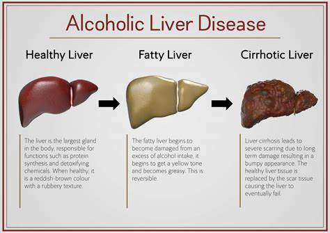 Cirrhosis As Related To Alcoholic Liver Disease Pictures