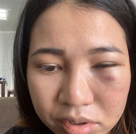 亚裔女子在美搭地铁时突遭暴力抢劫，脸被打肿
