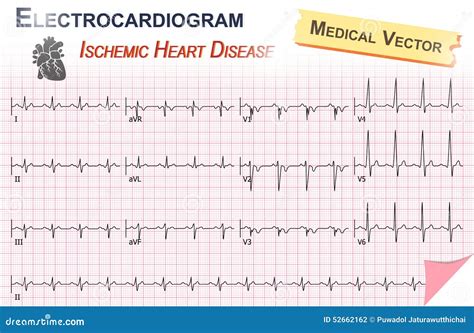 Difference Between Ecg And Cardiogram