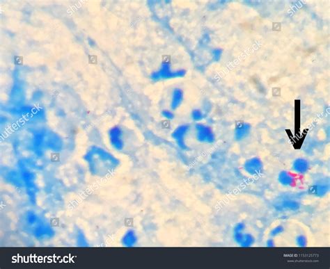 24 Ziehl Neelsen Stain Images, Stock Photos & Vectors | Shutterstock