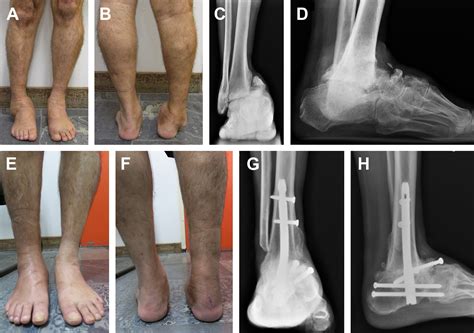 Arthrodesis in the Deformed Charcot Foot - Foot and Ankle Clinics