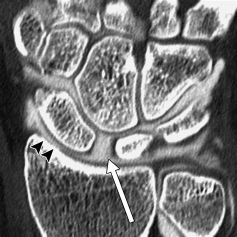 Scapholunate Advanced Collapse and Scaphoid Nonunion Advanced Collapse: MDCT Arthrography ...