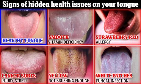Bumps On Back Of Tongue