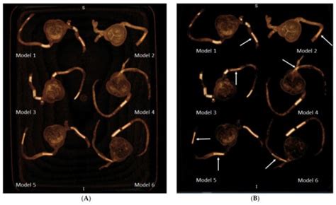 3D-Printed Coronary Plaques to Simulate High Calcification in the ...