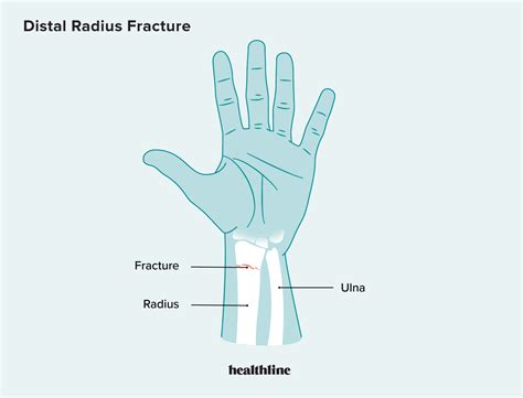 Image result for Distal Radius Fracture Recovery