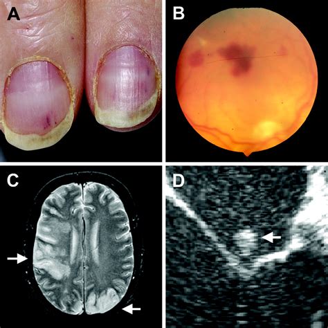 Systemic Complications of Infective Endocarditis | Circulation