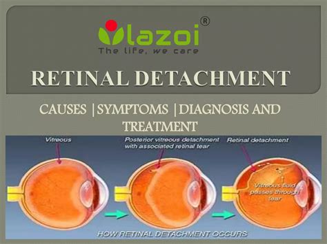 Retinal detachment : Causes, symptoms and treatment | PPTX
