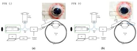 Assessing the Impact of PRESERFLO MicroShunt on Intraocular Pressure in ...