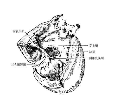 图24-13 巨大膜部室间隔缺损一例标本示意图-心脏外科基础图解-医学