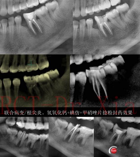 牙体牙髓病历分享-夏杨涛的博客-KQ88口腔博客