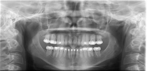 Los Angeles Panoramic Xray Best Advanced Dental Imaging