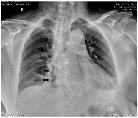 Boerhaave Syndrome—Narrative Review