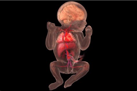 Image result for Heart Abnormal Development