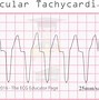 Image result for ventricular