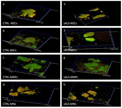 Patients’ Stem Cells Differentiation in a 3D Environment as a Promising ...