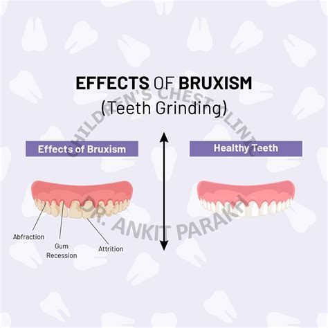 Teeth Grinding or Bruxism in Children - Dr. Ankit Parakh – India's best Pediatric Pulmonologist ...