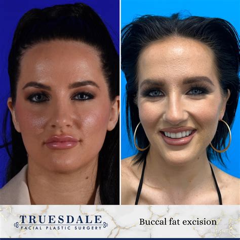 Buccal Fat Removal Celebrities 60 Photos - Moonagedaydream.film