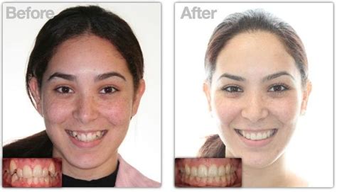 Get Rid Off Wire Braces With Invisible Braces - Health, Beauty ...