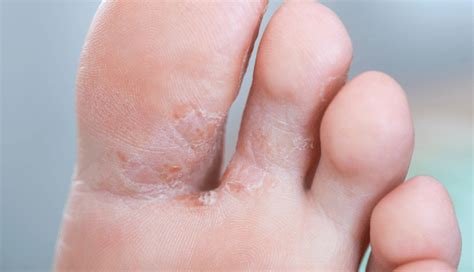 10 Home Remedies To Treat Athlete’s Foot - lifeberrys.com