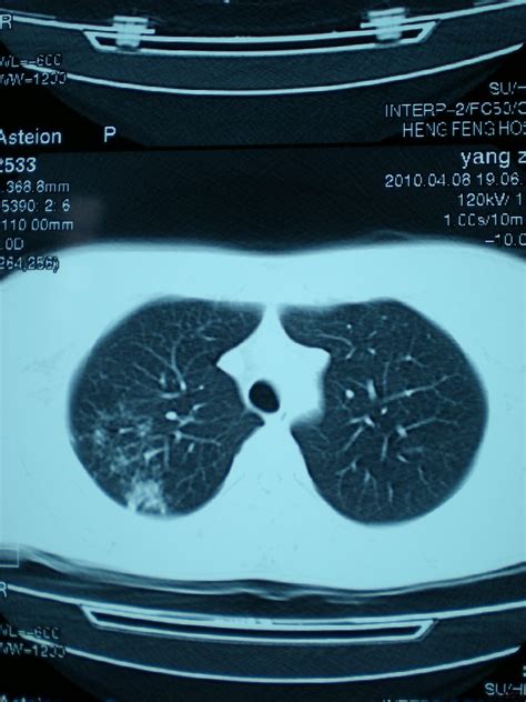 肺结核的诊断