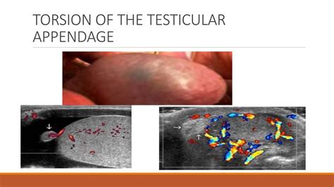 Testicular Torsion (Surgical emergency) .pptx