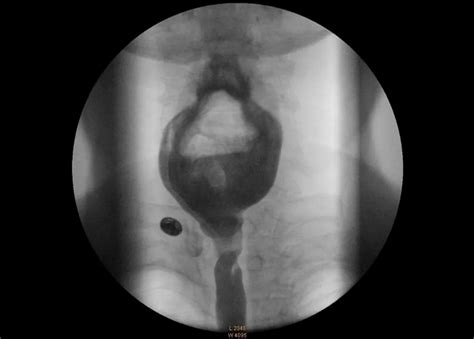 Philips - Zenition 50 - Mobile C-arm with Image Intensifier