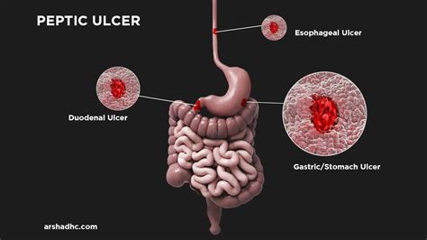 Best Peptic Ulcer Treatment in Rawalpindi | Gastric & Duodenal Ulcer ...