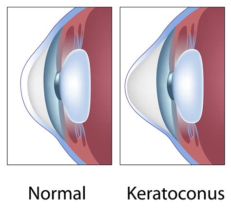 Corneal Cross-linking | Keratoconus