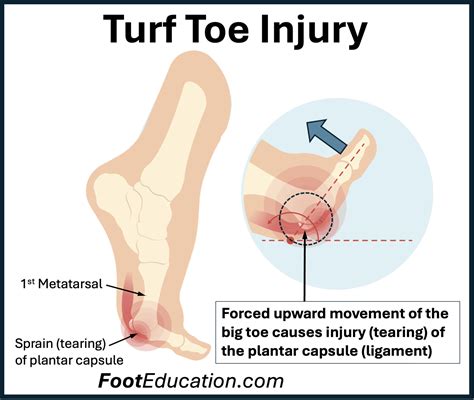 Turf Toe - FootEducation