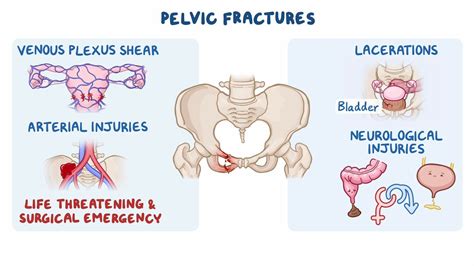 Video: Pelvic fractures: Clinical sciences | Osmosis