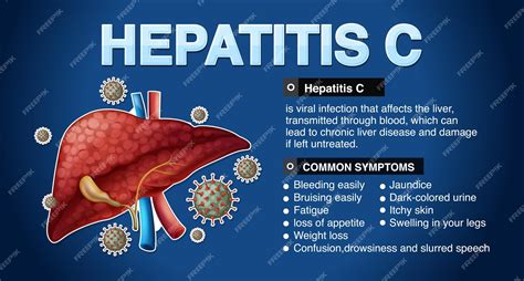 Free Vector | Symptoms of hepatitis c infographic