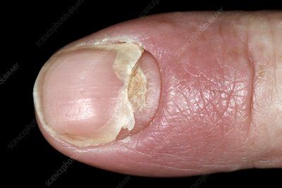 https://media.sciencephoto.com/image/c0475920/400wm/C0475920-Damaged_nail_after_nail_infection.jpg?utm_source=chatgpt.com