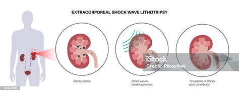 Lithotripsy Procedure 的图像结果