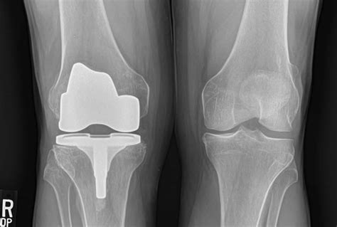 Knee Osteoarthritis - An Overview - Robert Howells