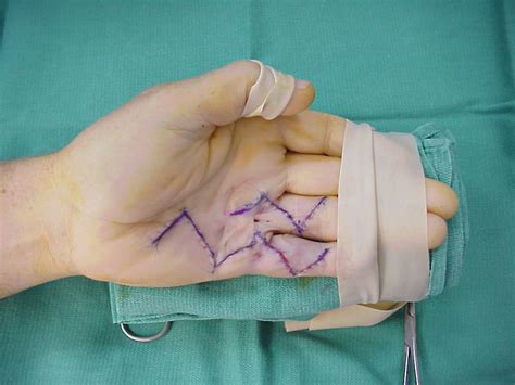 Bildergebnis für dupuytren's surgery pictures