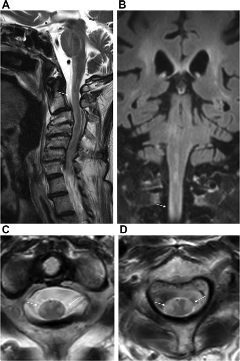 Toxic and Drug-Related White Matter Diseases of the Brain and Spine - Magnetic Resonance Imaging ...