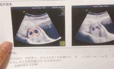 六周的孕囊能看出懷幾個孩子嗎？孕早期通過孕囊形狀看男女不靠譜