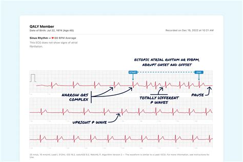 Sinus Rhythm Vs. Ectopic Atrial Rhythm on Your Watch ECG | Qaly