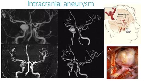 Magnetic Resonance Angiography and Venography | PPTX