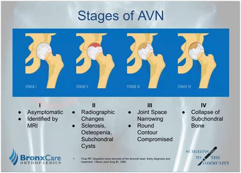 What Is Avascular Necrosis Of Hip at Mary Smithey blog
